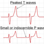 hyperkaliemia