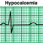 hypocalcemia