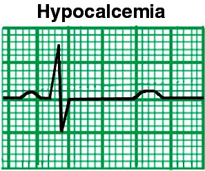 hypocalcemia